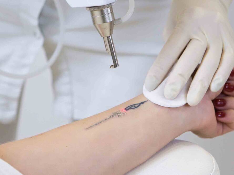 Laser tattoo removal in New Westminster
