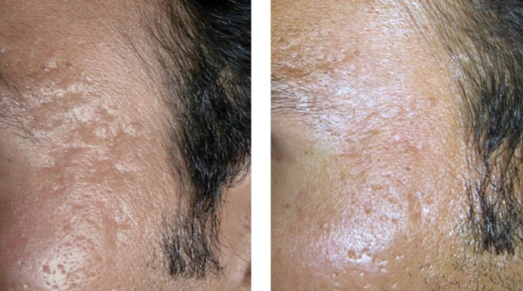 Micro-needling Before & After Photo 3