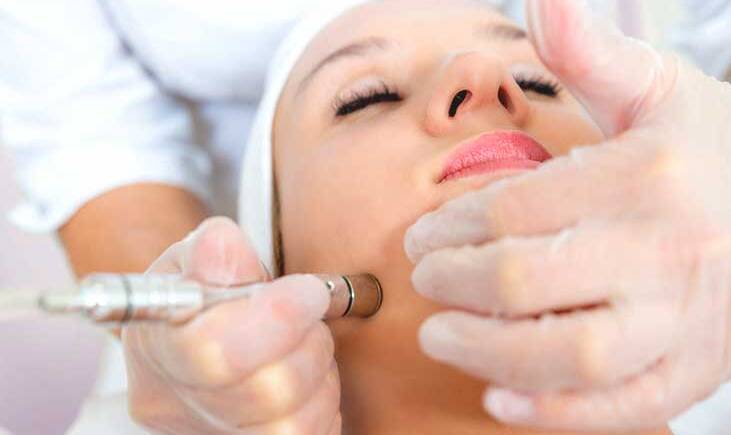 Microdermabrasion treatment in Vancouver