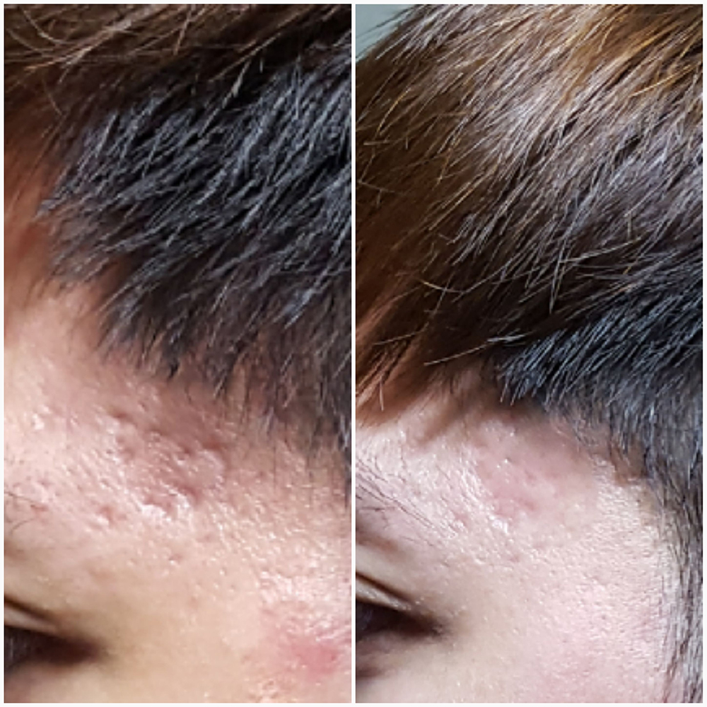 Micro-needling Before & After Photo 4