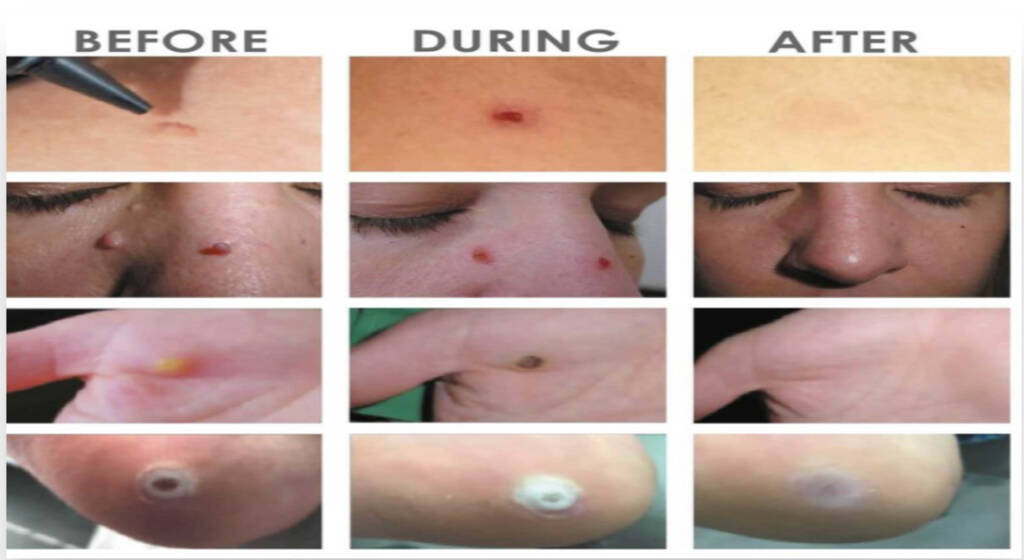 Skin Tag Removal in New Westminster