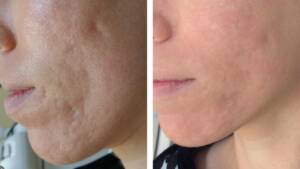 Microneedling Before after photo 1