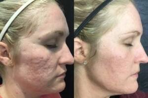 Microneedling Before & After Photo 2