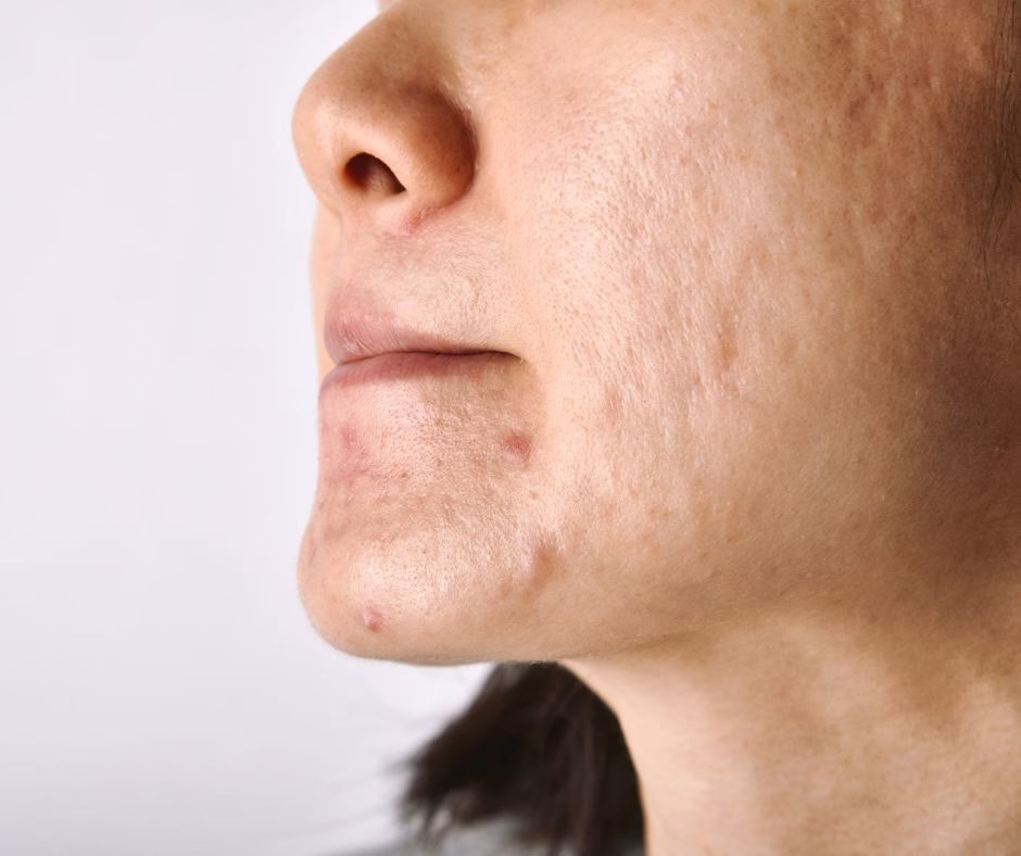 RF Microneedling Treatment