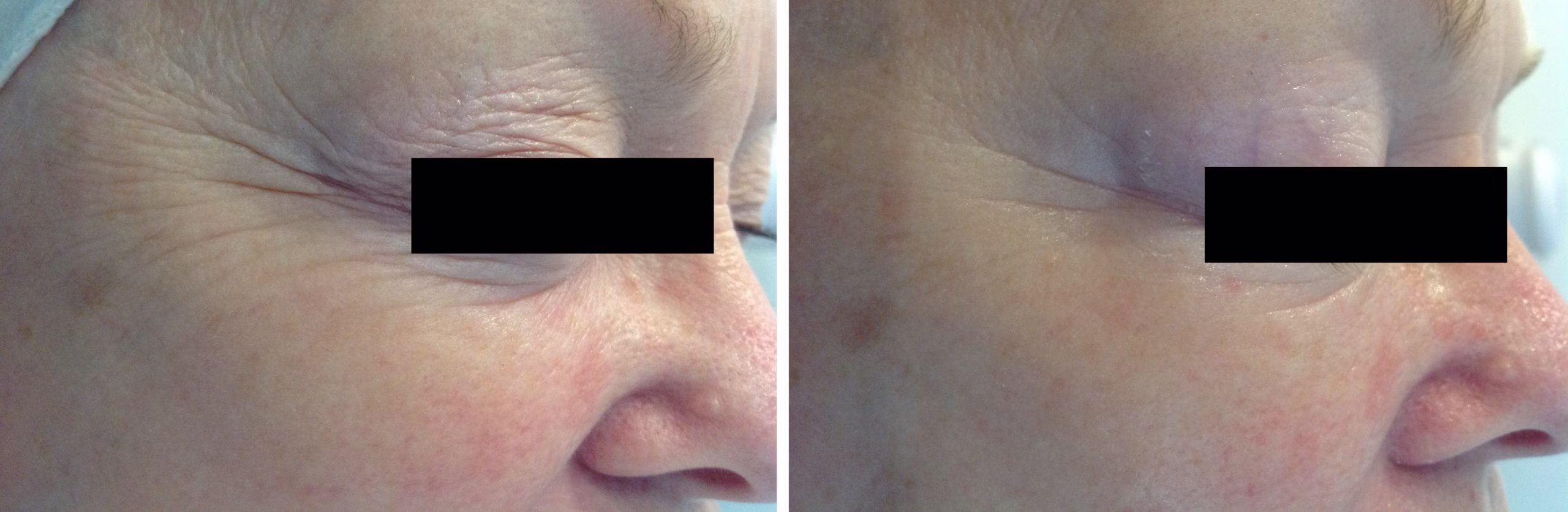 OxyGeneo Super Facial at New Westminster