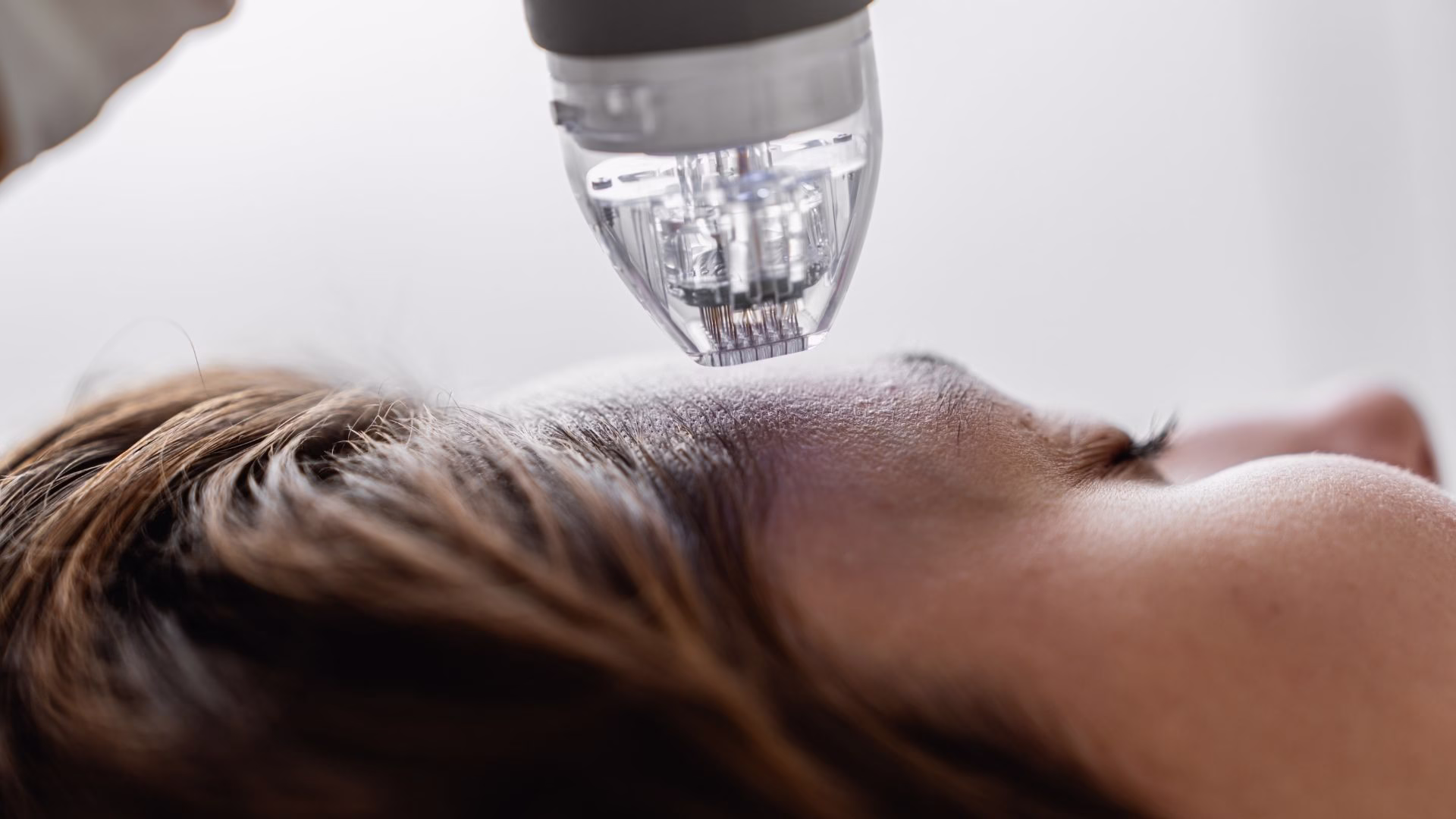 Microneedling Collagen Boost in Vancouver