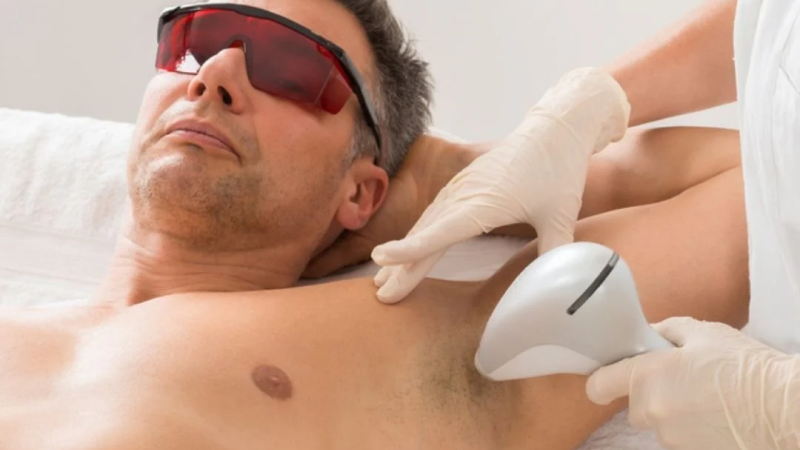 Laser hair removal chest and underarm treatment men