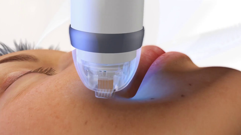 RF microneedling device skin close up