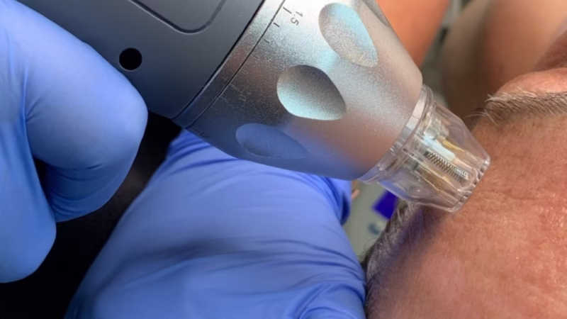 RF microneedling device used on forehead for skin tightening and wrinkle reduction
