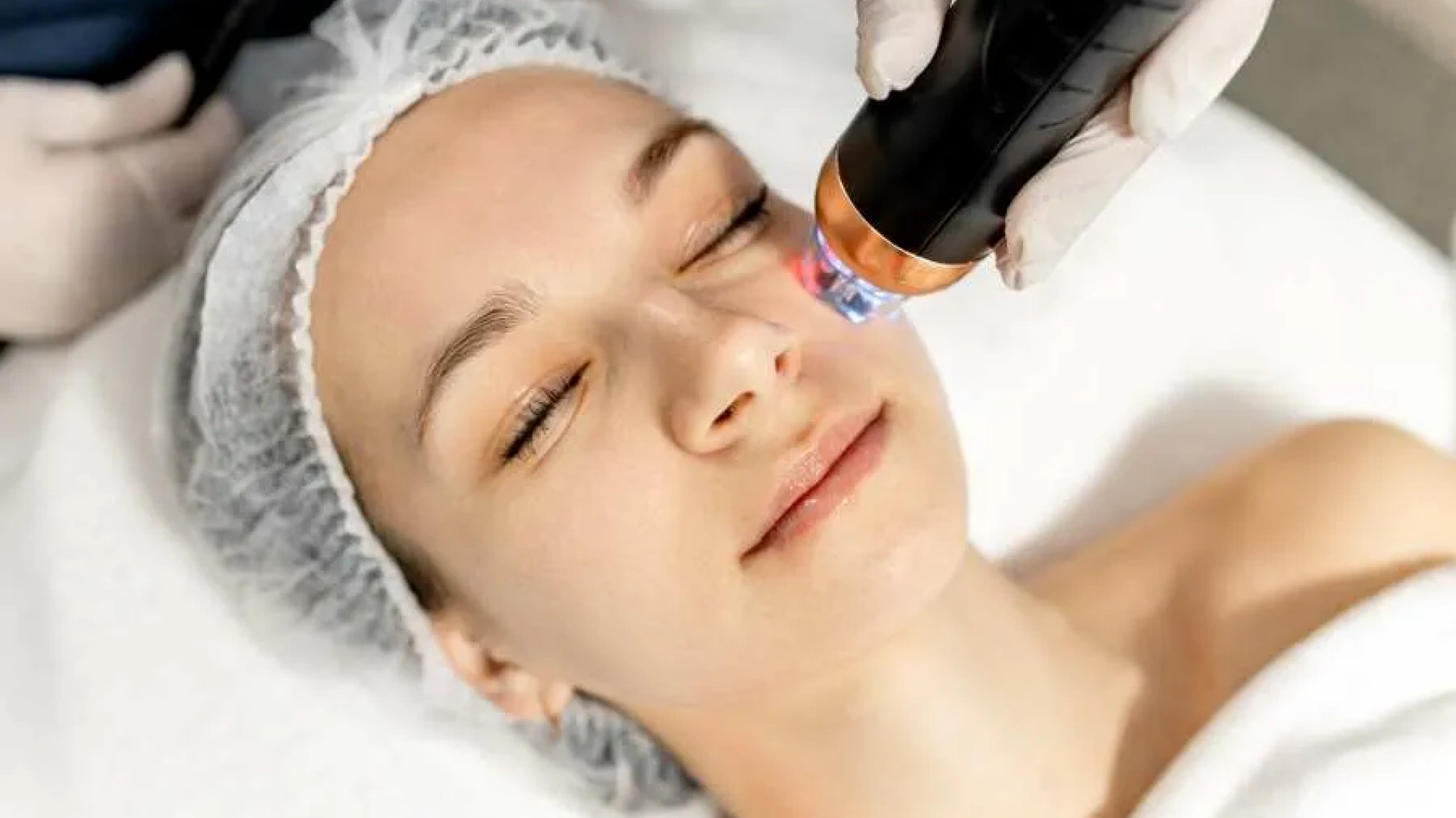 RF micro needling radio frequency before and after results maintenance. 