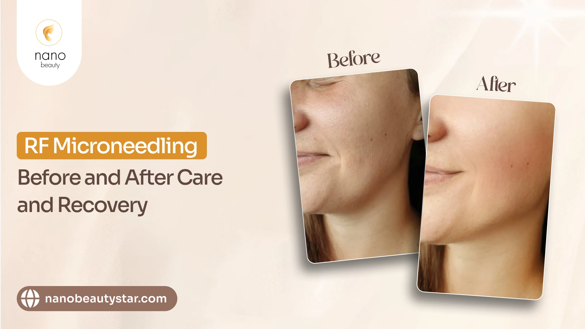 Micro needling radio frequency before and after care guide.