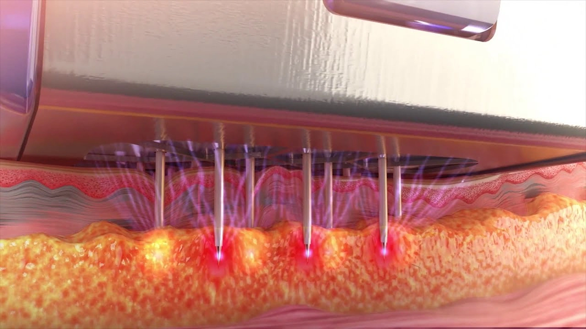 Results of RF micro needling radio frequency before and after. 