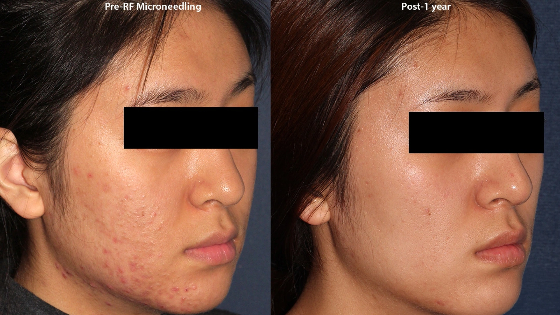 RF micro needling radio frequency before and after photos look.