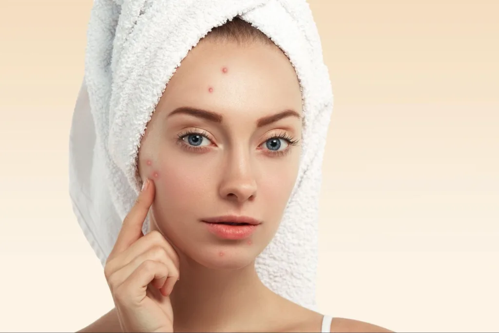 Secret radio frequency treatment for acne scars with advanced skin rejuvenation solutions.
