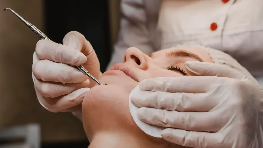 Secret RF for acne scars and benefits of Secret RF microneedling.