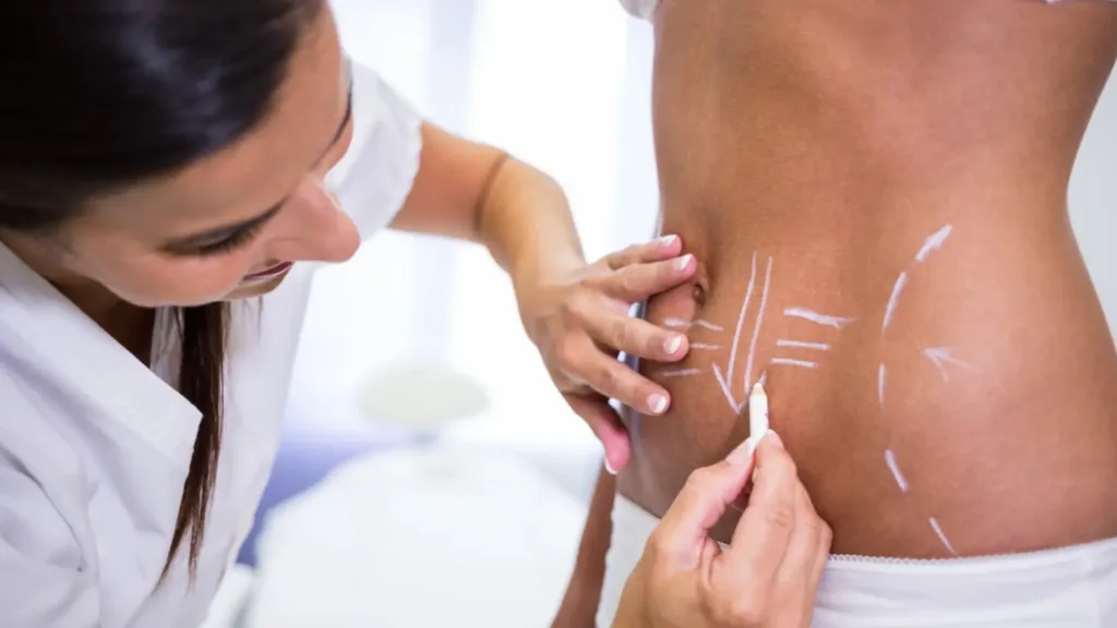 Secret RF microneedling benefits for stretch marks and skin renewal.