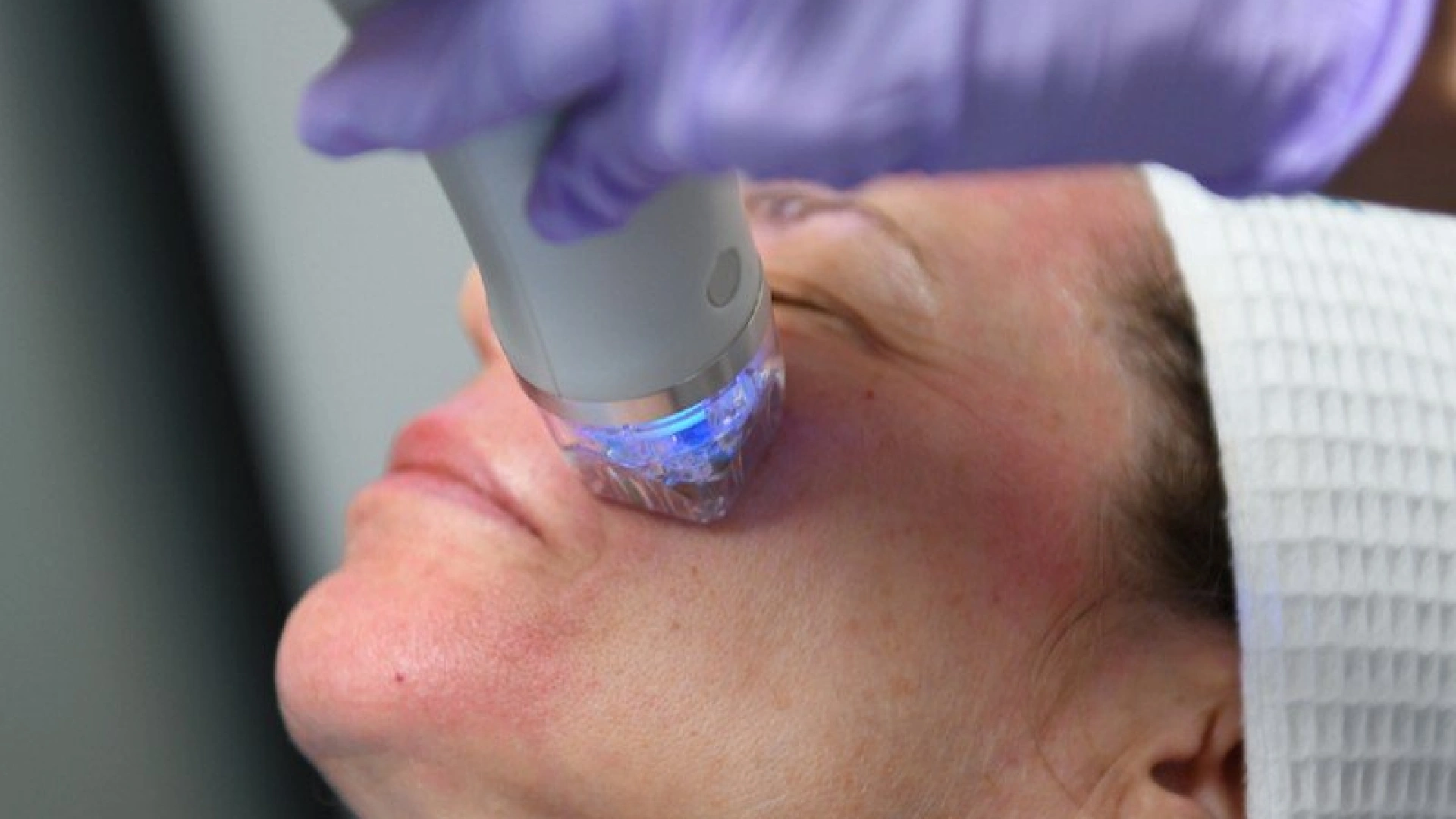 RF micro needling radio frequency before and after care precautions.