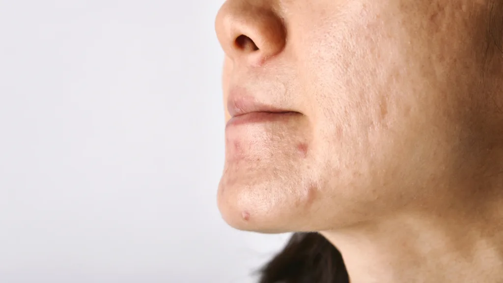 Secret RF vs Profound RF treatment options for acne scars and uneven skin texture. 