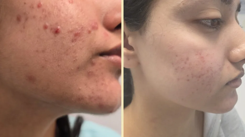 Before and after results comparing Secret RF vs Profound RF treatments. 