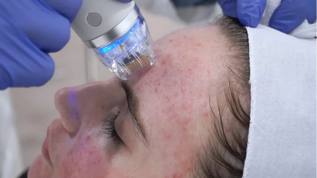 Secret RF results may vary based on individual skin concerns and treatment plans. 