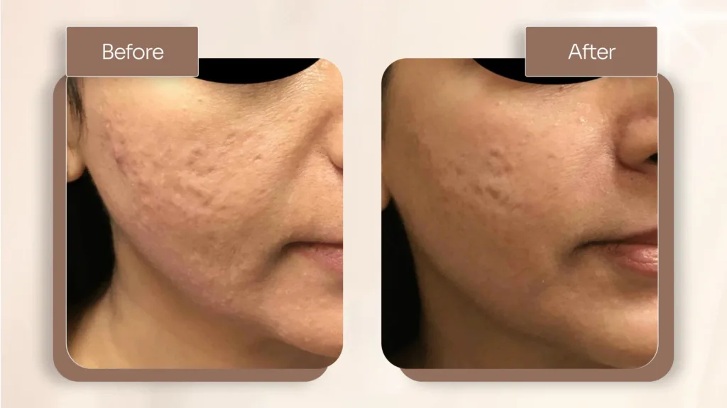 Comparing Secret Pro RF vs Secret RF treatment results and outcomes. 