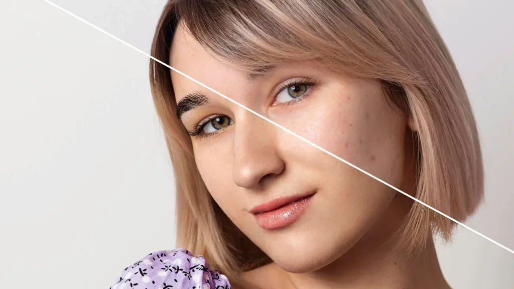 Secret RF vs profound RF for enlarged pores and skin texture refinement. 