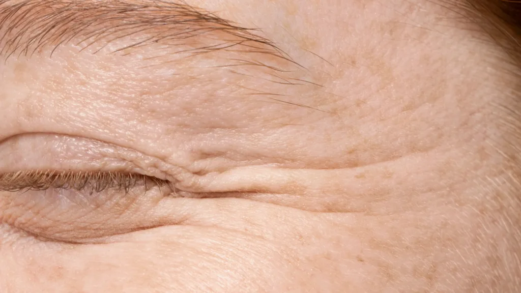 Profound RF vs Secret RF treatment for fine lines and wrinkles. 
