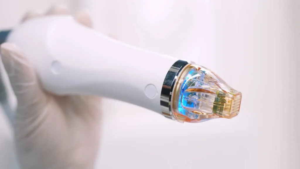 Provider experience plays an important role in achieving optimal secret rf microneedling results. 