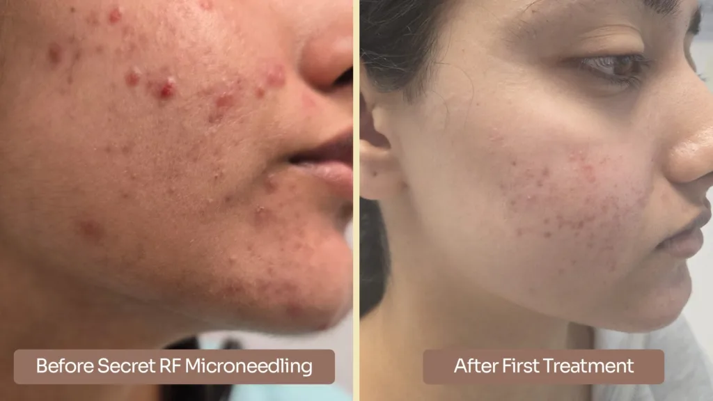 Learn about Secret RF before and after 1 treatment outcomes. 