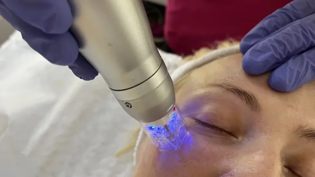 Secret rf microneedling cost in Vancouver price breakdown.