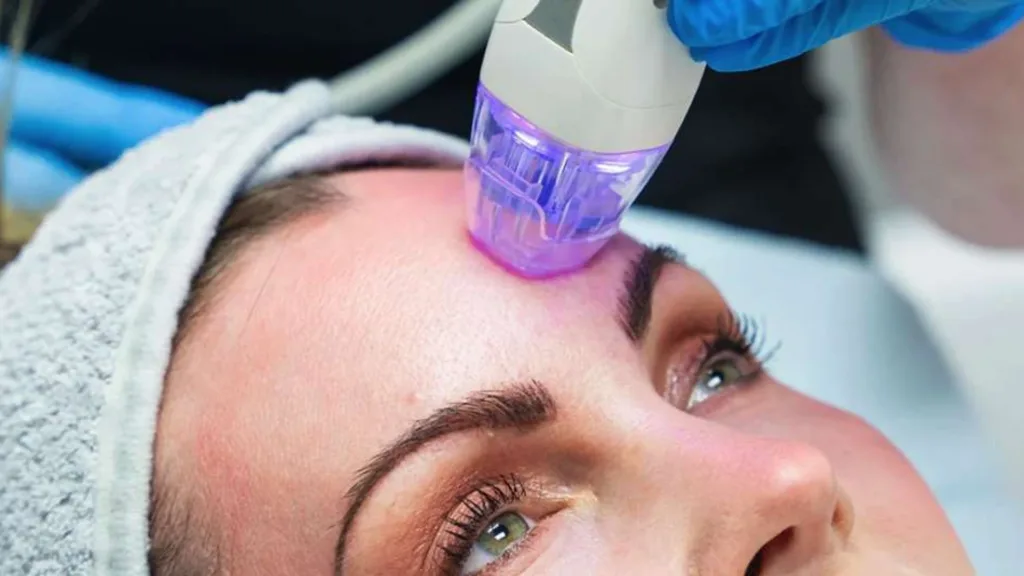 Secret rf price in Vancouver for face and neck treatment.