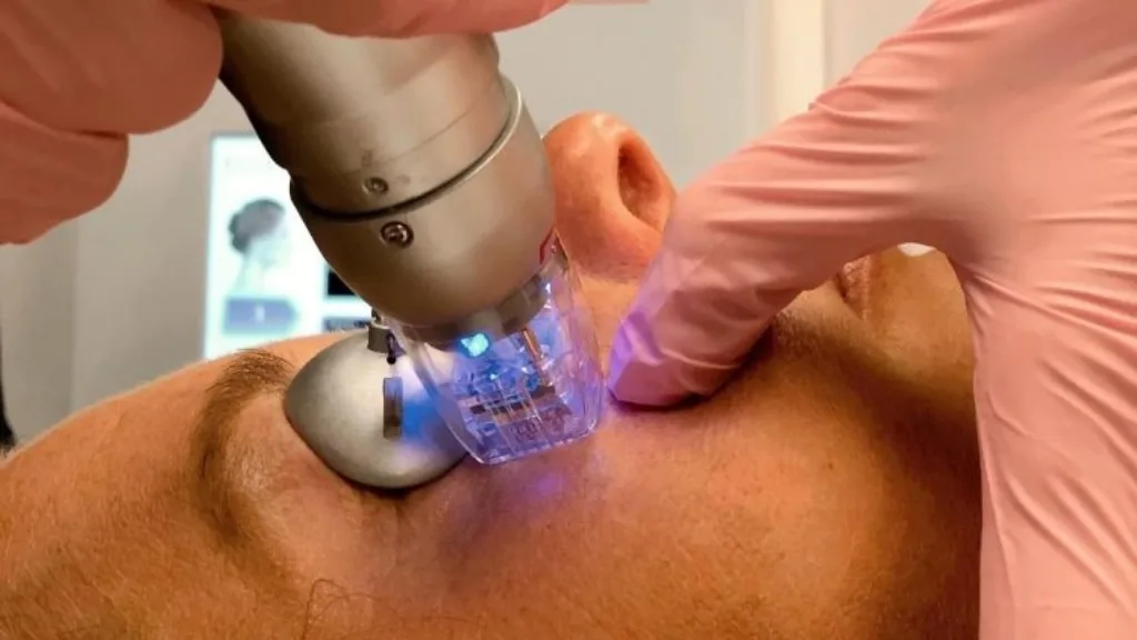 Secret rf treatment cost in Vancouver by treatment area.