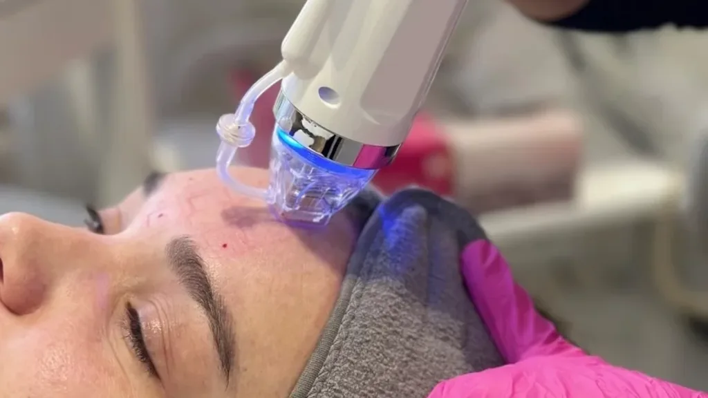 Severity of skin concerns secret rf price in Vancouver skin care information.