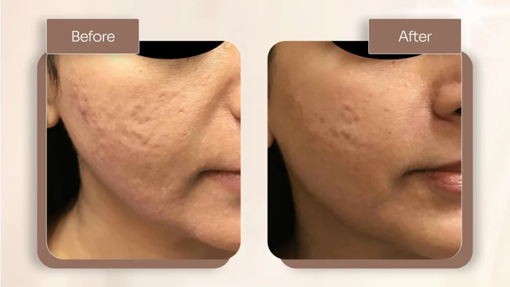 Secret RF microneedling results can differ from patient to patient depending on skin condition, treatment plan, and response to the procedure. 
