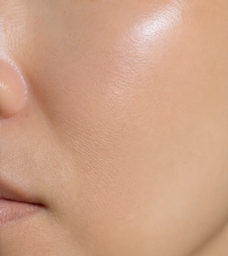 After Melasma treatment