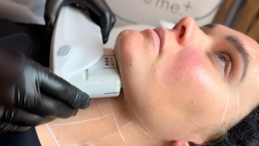 RF HIFU facial combines radiofrequency and high intensity focused ultrasound technology. 