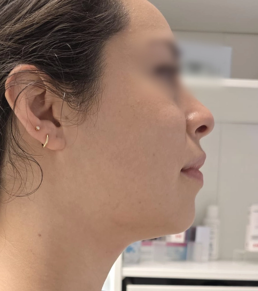 After 12D HIFU treatment