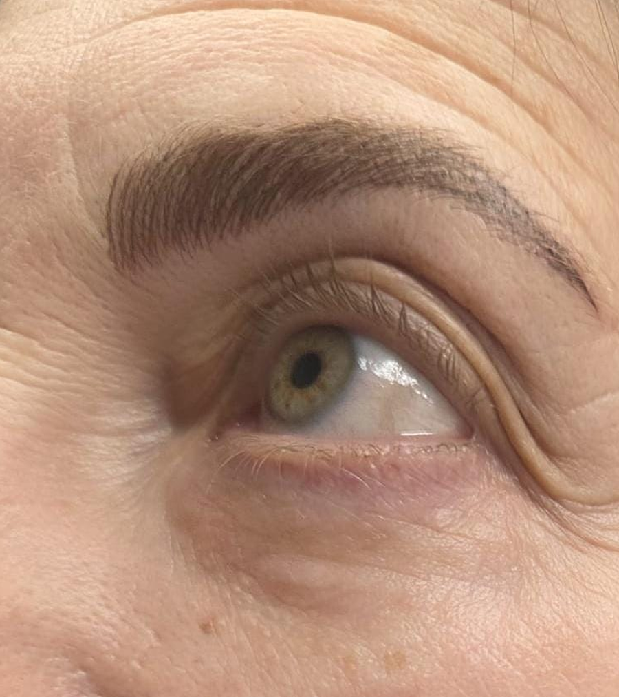 After Microblading treatment