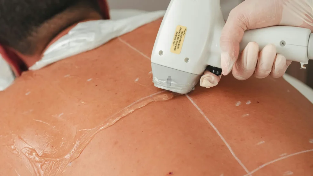 Choosing laser hair removal technology for your skin and hair.