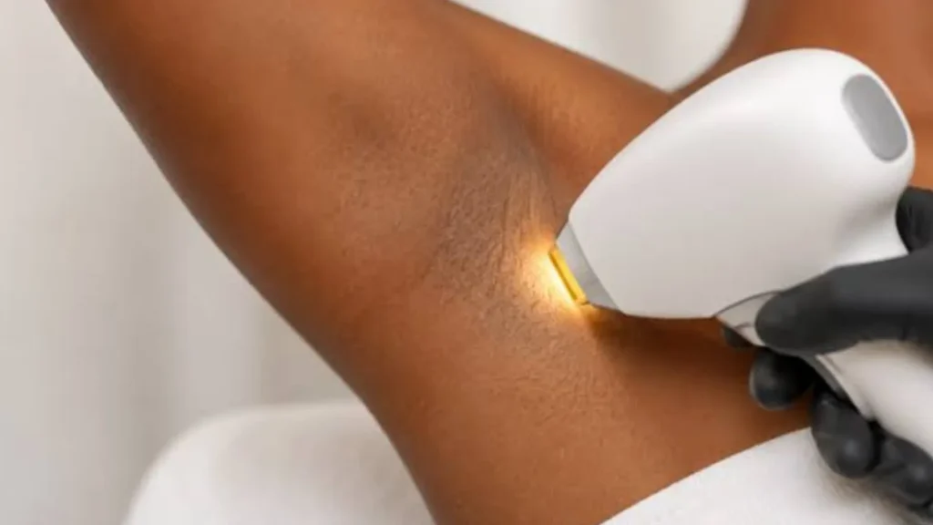 Nano Beauty Star - laser hair removal for dark skin Vancouver.
