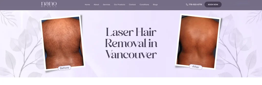 Nano Beauty Star - laser hair removal dark skin Vancouver.