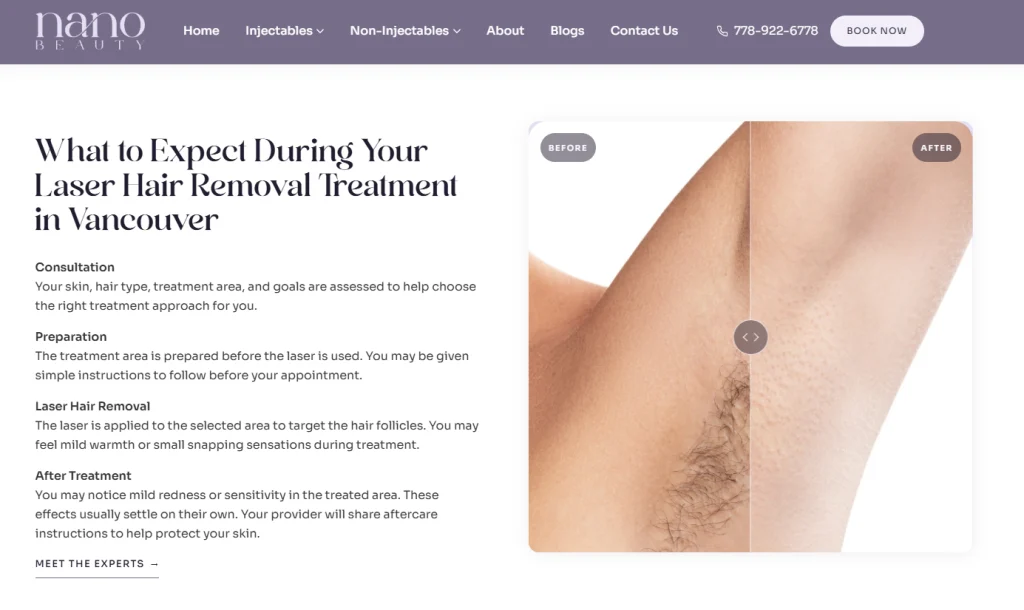 Nano Beauty Star laser hair removal treatment process.