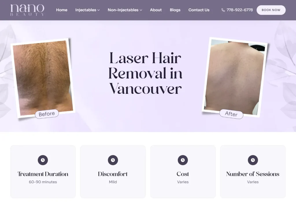 Nano Beauty Star - top laser hair removal Vancouver.