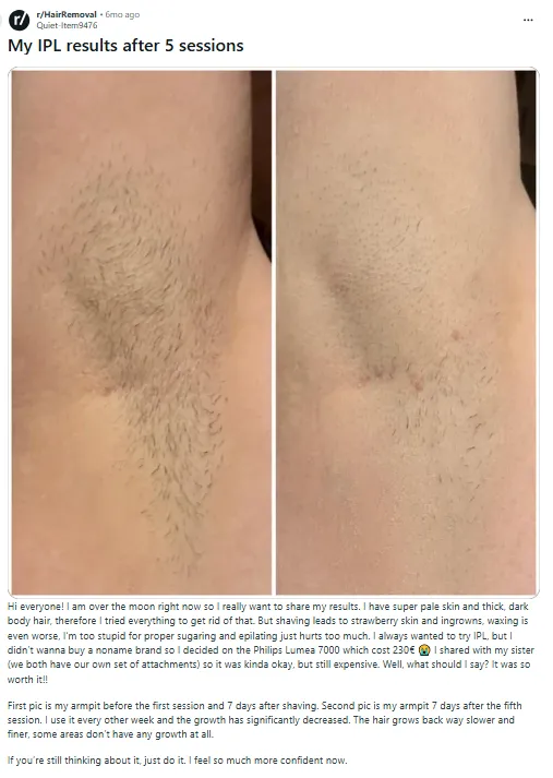 Reddit experience with IPL hair removal.