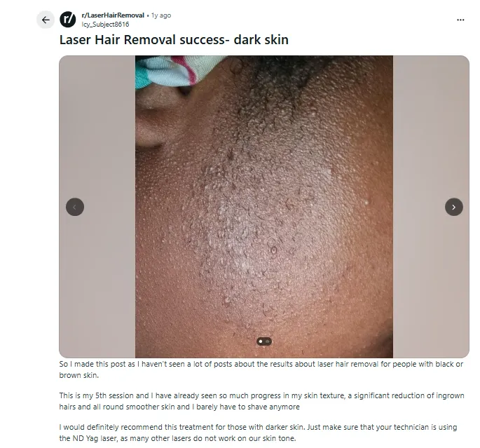 Reddit discussion on Nd:YAG laser hair removal for dark skin.